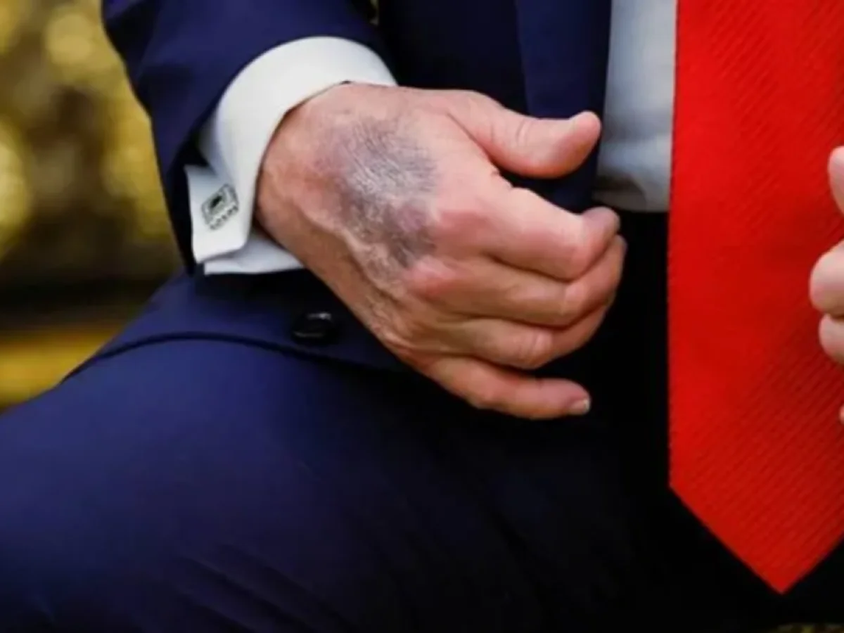 Trump elindeki morlukların sebebini açıkladı; yüksek doz aspirin!